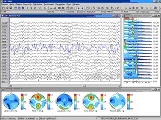 Топографическое картирование спектров ЭЭГ